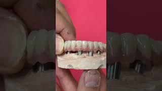 Another option for Full Mouth Implants!