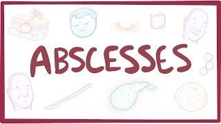 Abscesses - causes, symptoms, diagnosis, treatment, pathology