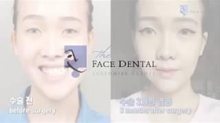 After jaw surgery