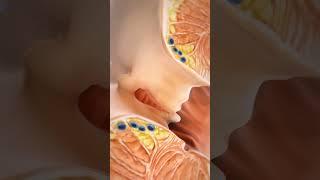 Anal Fissure Laser Surgery Treatment #viral