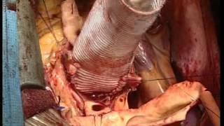 Aortic Valve Sparring Root Replacement (Yacoub Technique)