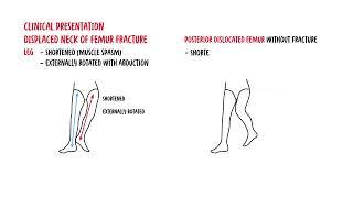 Understanding Neck of Femur Fractures