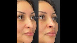 Non-Surgical Nose Job + Mint PDO Nose Tip Lift - Ageless MD