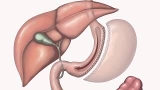 Bariatric Surgery | Types of surgery | 2/3