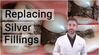 Replacing Silver Fillings with Biomimetic Dentistry | When, Why, and How to replace Amalgam