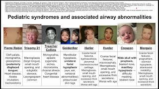 Pediatric syndromes and associated airway abnormalities